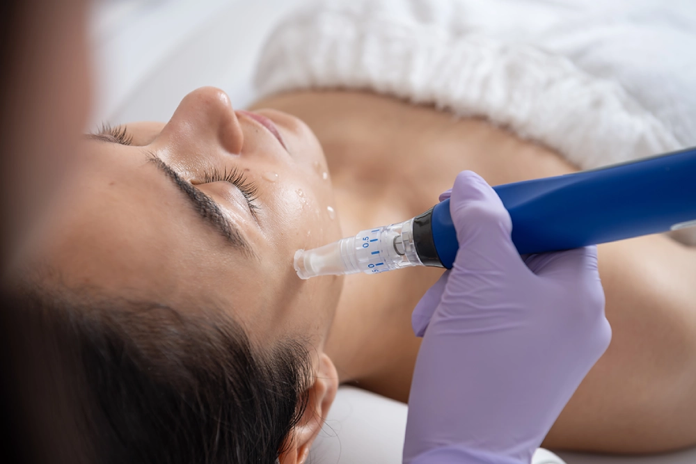 Microneedling Procedure